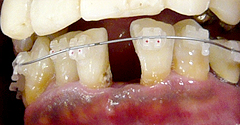 歯周病時の矯正治療