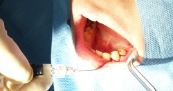 歯周再生治療により、エムドゲインを注入
