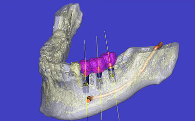 下歯槽神経の3D分析