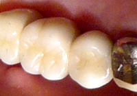 上部構造の白い歯